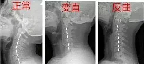 颈椎腰椎疾病自测方法