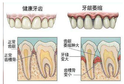 牙龈萎缩怎么恢复?