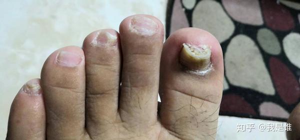 第一次得灰指甲是大学的时候,在杭州,脚上大脚趾,指甲盖基本掉的差不