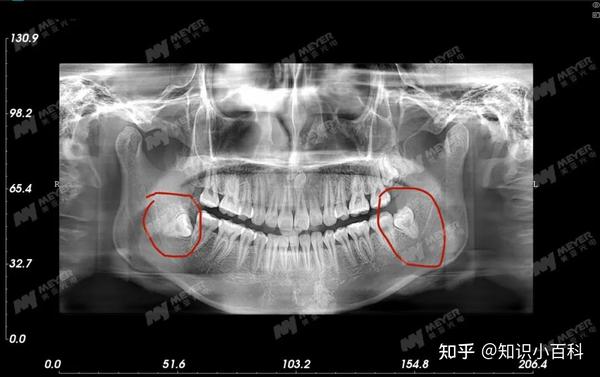 如何解答患者提问:拔智齿价格为啥不一样?