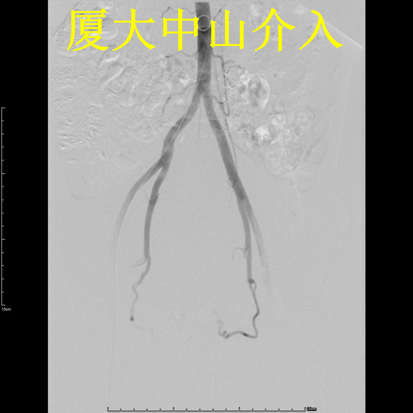 腹主动脉造影显示双侧子宫动脉
