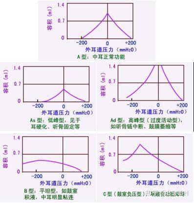 静态声顺值(static compliance value):外耳道与鼓室压力相等时的最大