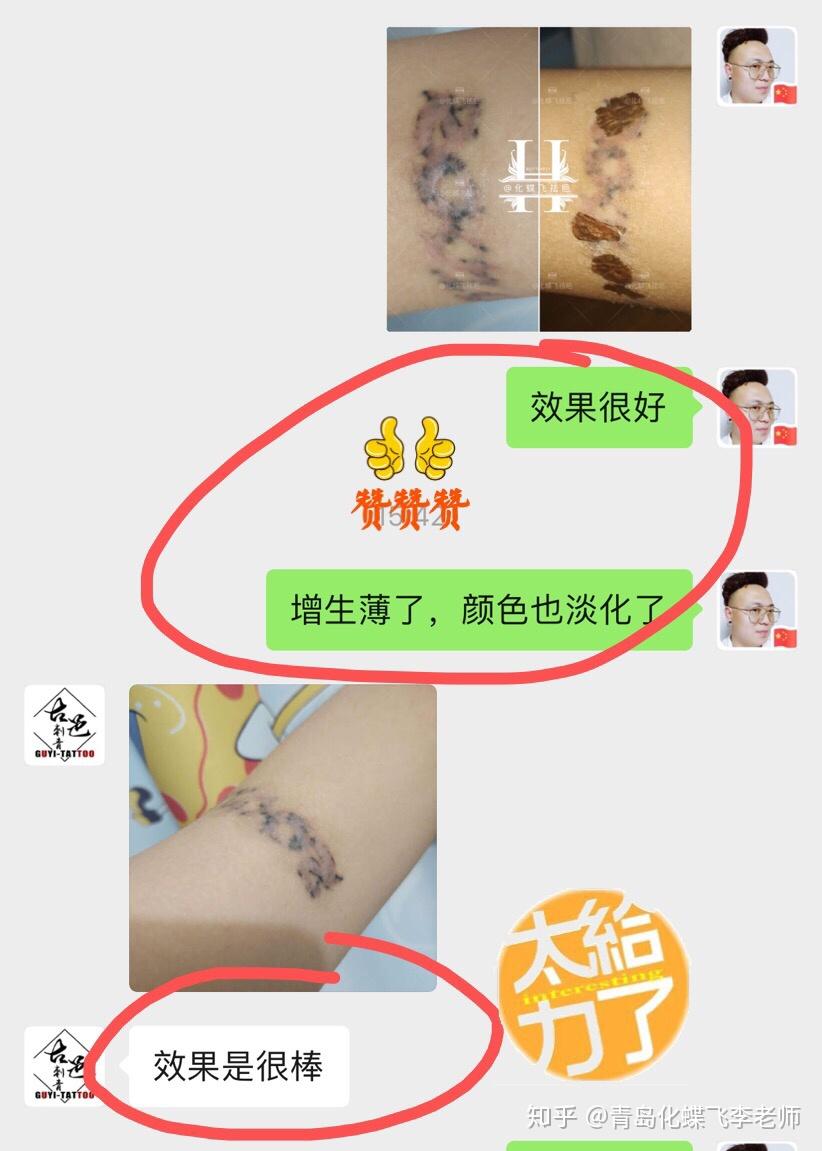 洗纹身增生疤痕使用中药修复代谢一次效果显著