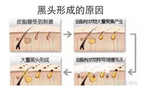 如何快速有效地去黑头