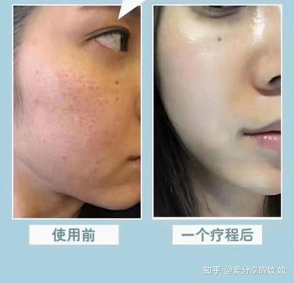 水光针原理注意事项常识又来啦