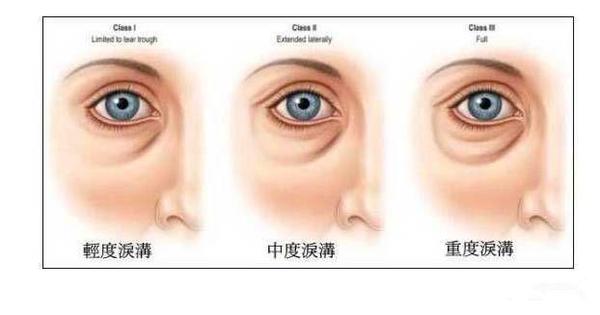 让你年轻10岁的秘诀: 解决掉黑眼圈,眼袋和泪沟!