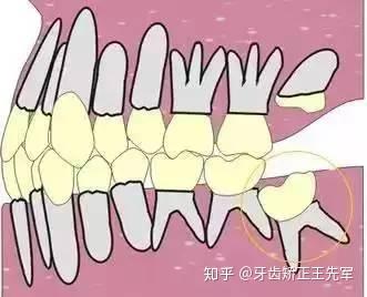 1,影响面部的危害:在出现牙错位的时候,除了会给患者面部造成严重的