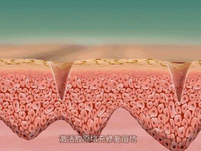 痘坑,是痘痘发炎感染而造成的真皮胶原纤维断裂,所形成的凹陷.