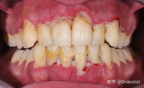 牙结石会沉积在牙根处,不断刺激牙龈,久而久之会导致牙周炎,逐渐牙龈