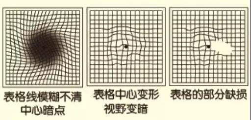 眼睛看东西扭曲变形警惕黄斑病变