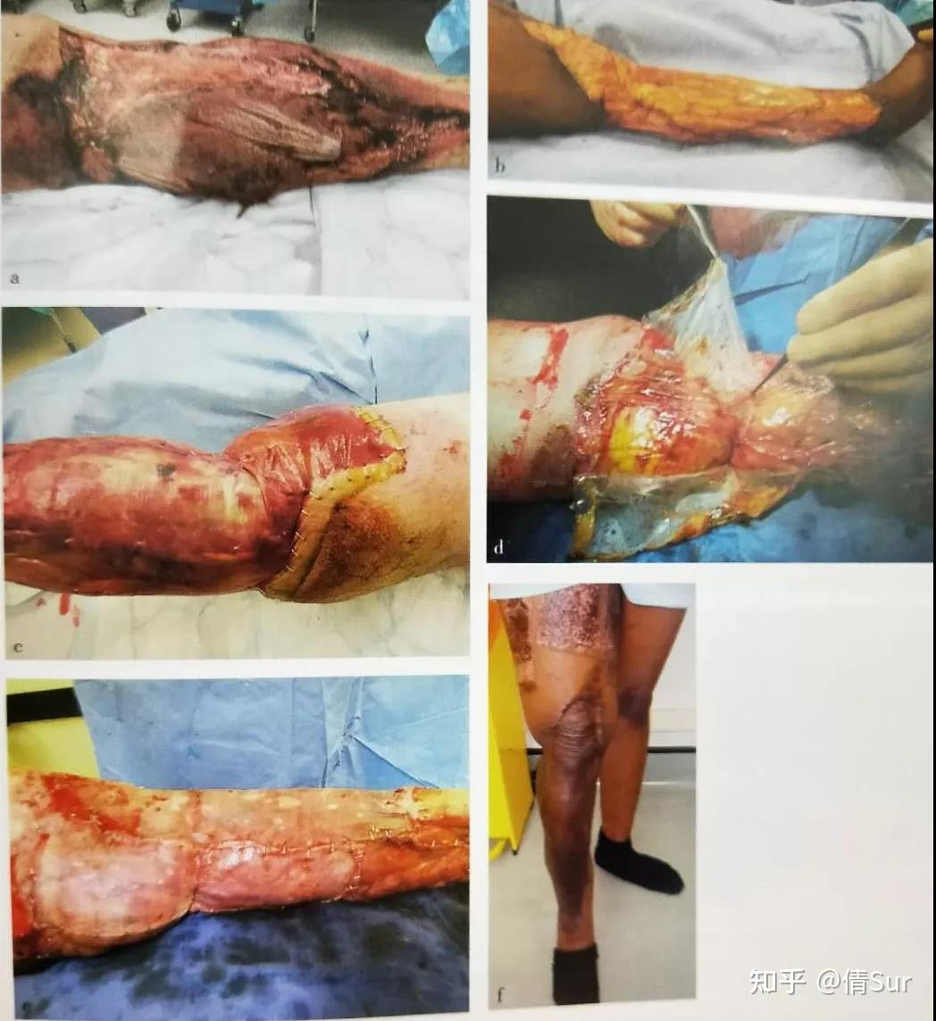 医院回应「猪躺手术台被剥皮移植」,称猪皮将用于覆盖