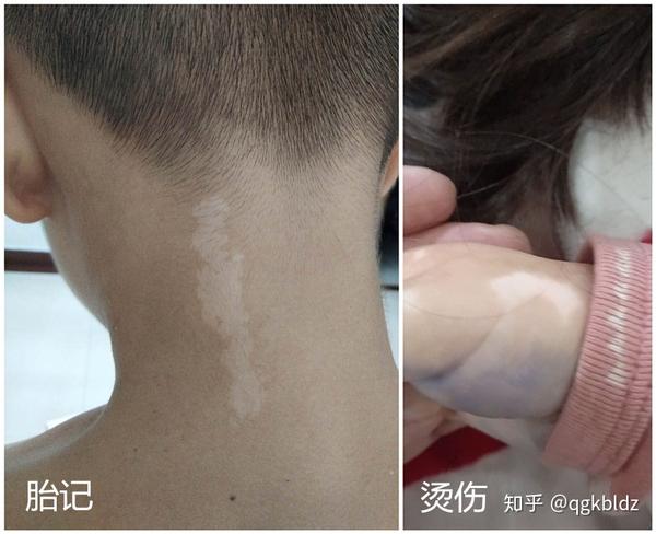 白癜风表皮移植与黑色素种植的区别