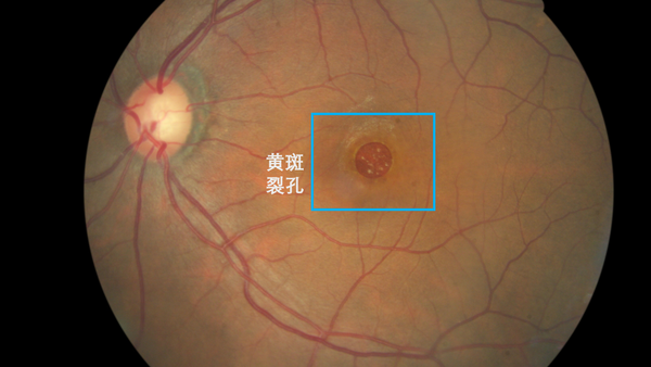 高度近视者 高度近视的患者存在视网膜变性,可能会导致视网膜裂孔.