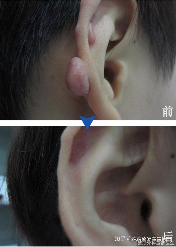 耳廓疤痕疙瘩治疗案例