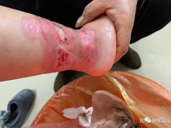 烫伤后如何判断是否留疤
