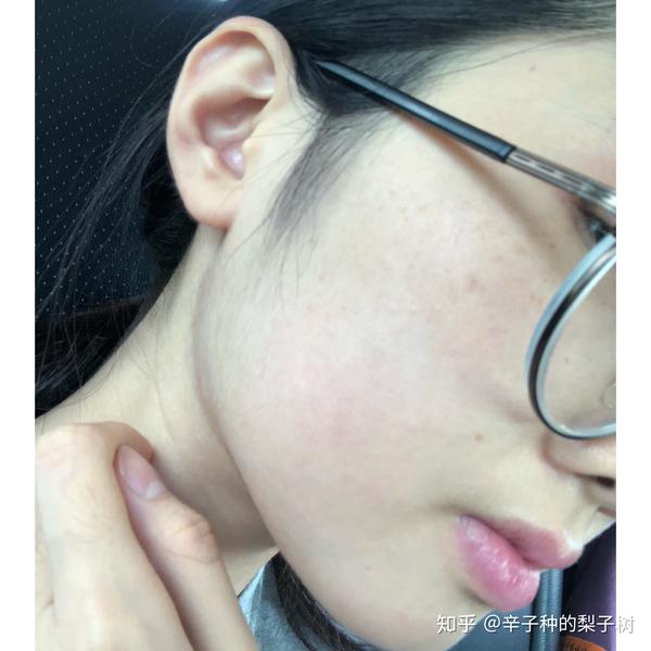 脸上长了很多又红又痒逆光疹子,有些透明的尖头看起来