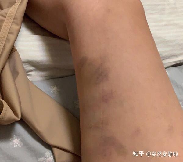 北京大腿吸脂手术经历分享