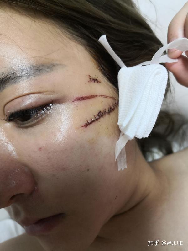 今天缝针第二天 缝了24针美容针 跪求各位给点意见 用什么比较好 怕长
