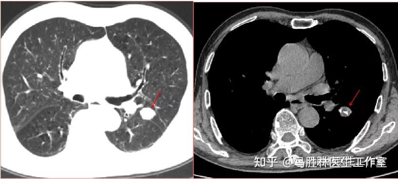 肿瘤科普肺结节影像说