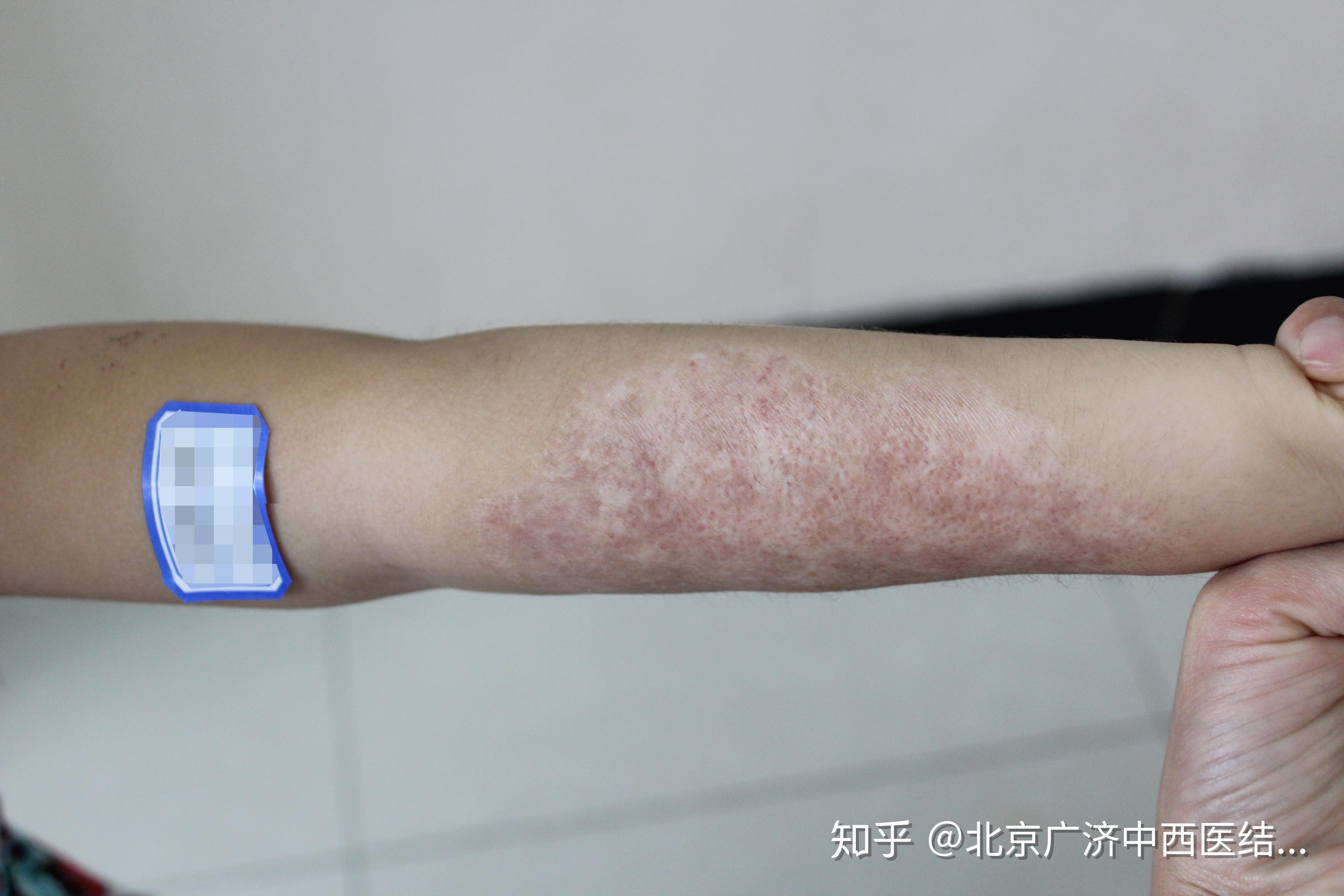 皮肤烧伤后,受伤组织局部色素细胞受损,代谢紊乱,真皮中存在的大量黑