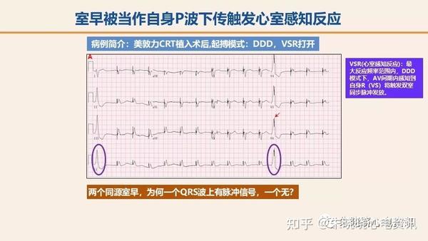 起搏器视角看起搏心电图 (ppt)