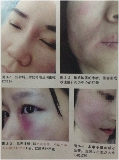 打玻尿酸要注意什么?