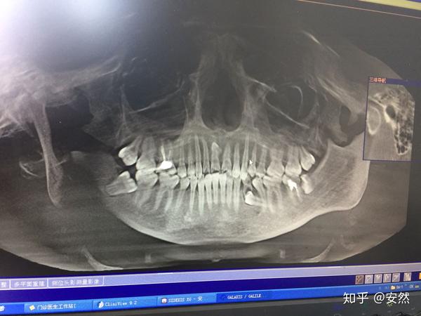 简直醉了,首先第一次手术拔掉了所有智齿和多生牙5颗牙齿,后期矫正