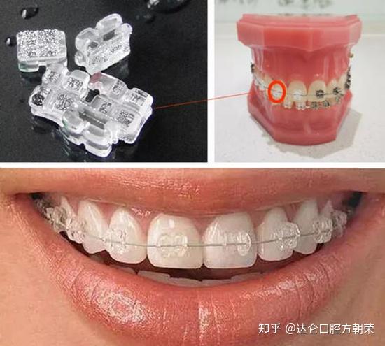 先佩戴个性化的颞颌关节矫正器调整牙弓和颞颌关节功能问题,然后开始