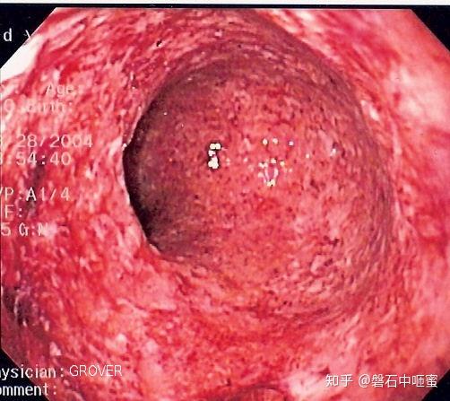 克罗恩病 crohn's disease