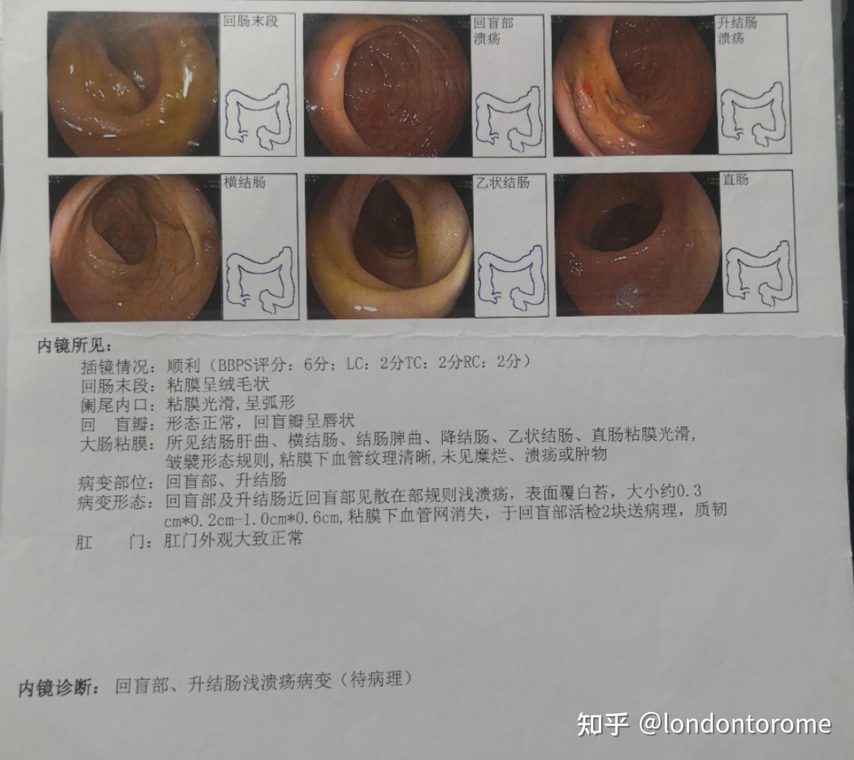 肠道溃疡引发的焦虑克罗恩or其他