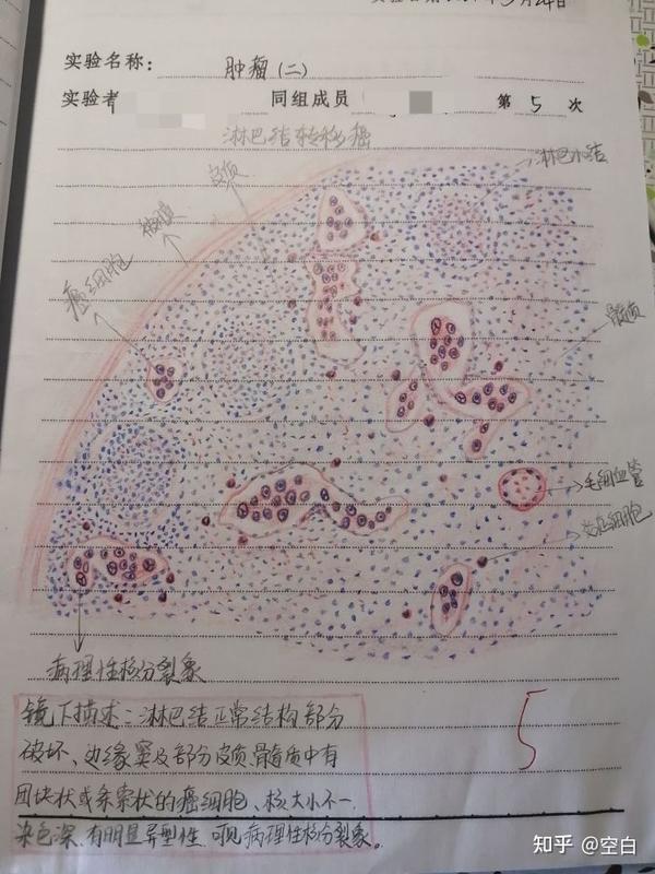 ⑥风湿性心肌炎