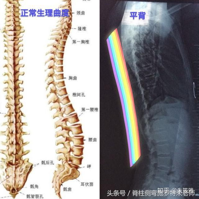 脊柱侧弯平背该如何矫正