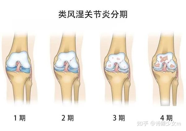 类风湿性关节炎为何青睐年轻女性?超短裙惹的祸?