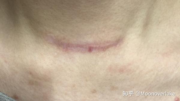 甲状腺切除术后疤痕恢复记录贴