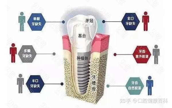 余杭口腔医院张春阳院长关于种植牙的那些事