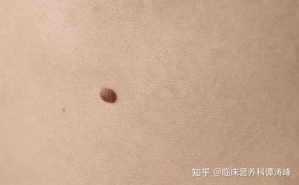 并不是所有的痣都是良性的!这3个部位的"痣"易