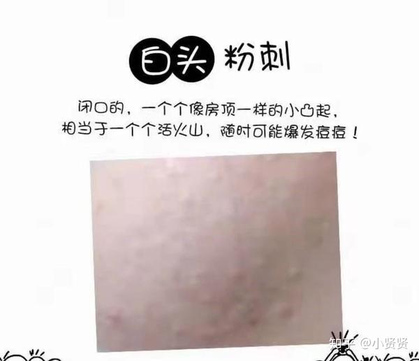 关于痘痘: 其实痘痘分很多种,比如闭口粉刺,丘疹,脓胞型痘痘,囊肿