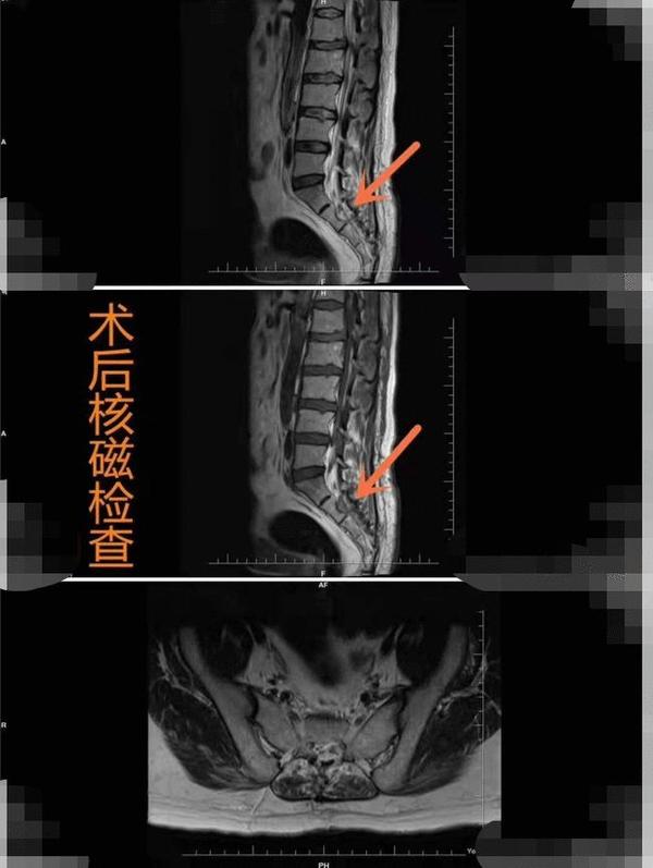 右下肢麻木疼痛,于当地医院行mri检查,诊断为"腰椎间盘突出,骶管肿瘤