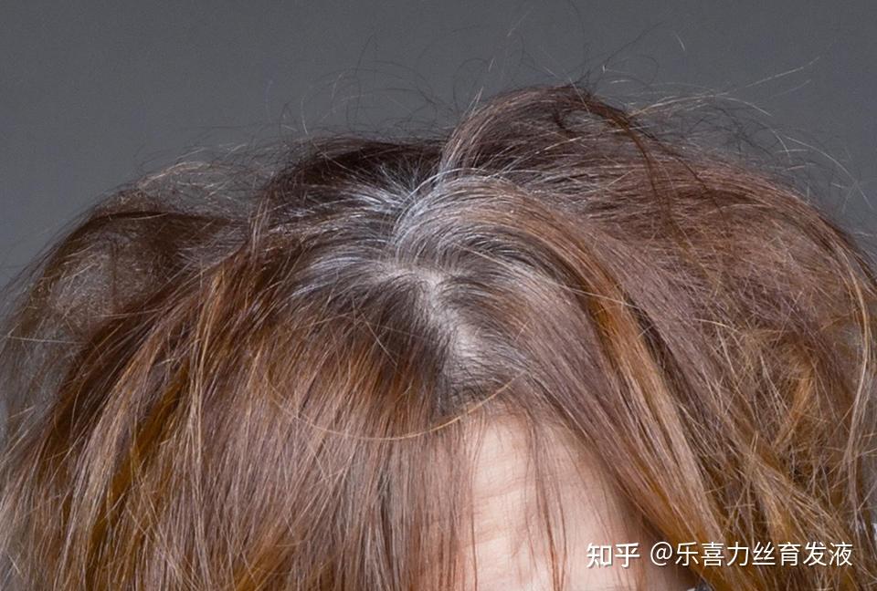 脱发能长时间戴假发吗戴假发有什么危害