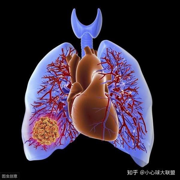 盟主教你识别肺栓塞症状