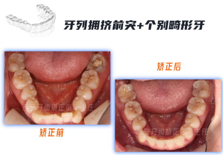 西安隐形矫正:拔除1颗正畸牙,片切下牙列扩弓上牙列