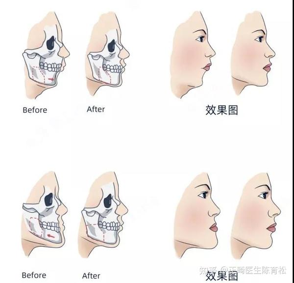 骨性凸嘴掩饰性正畸有用吗