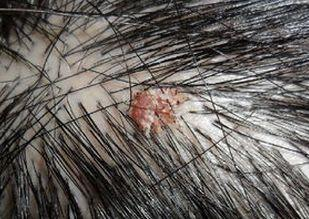 头皮上经常长小红疹小脓包是什么?