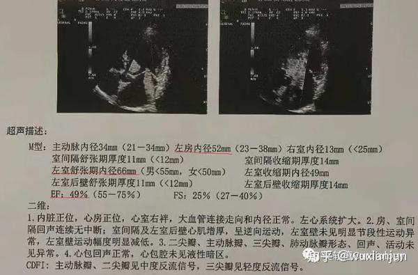 入院后完善心脏超声检查提示左心房及左心室明显增大,心脏收缩功能