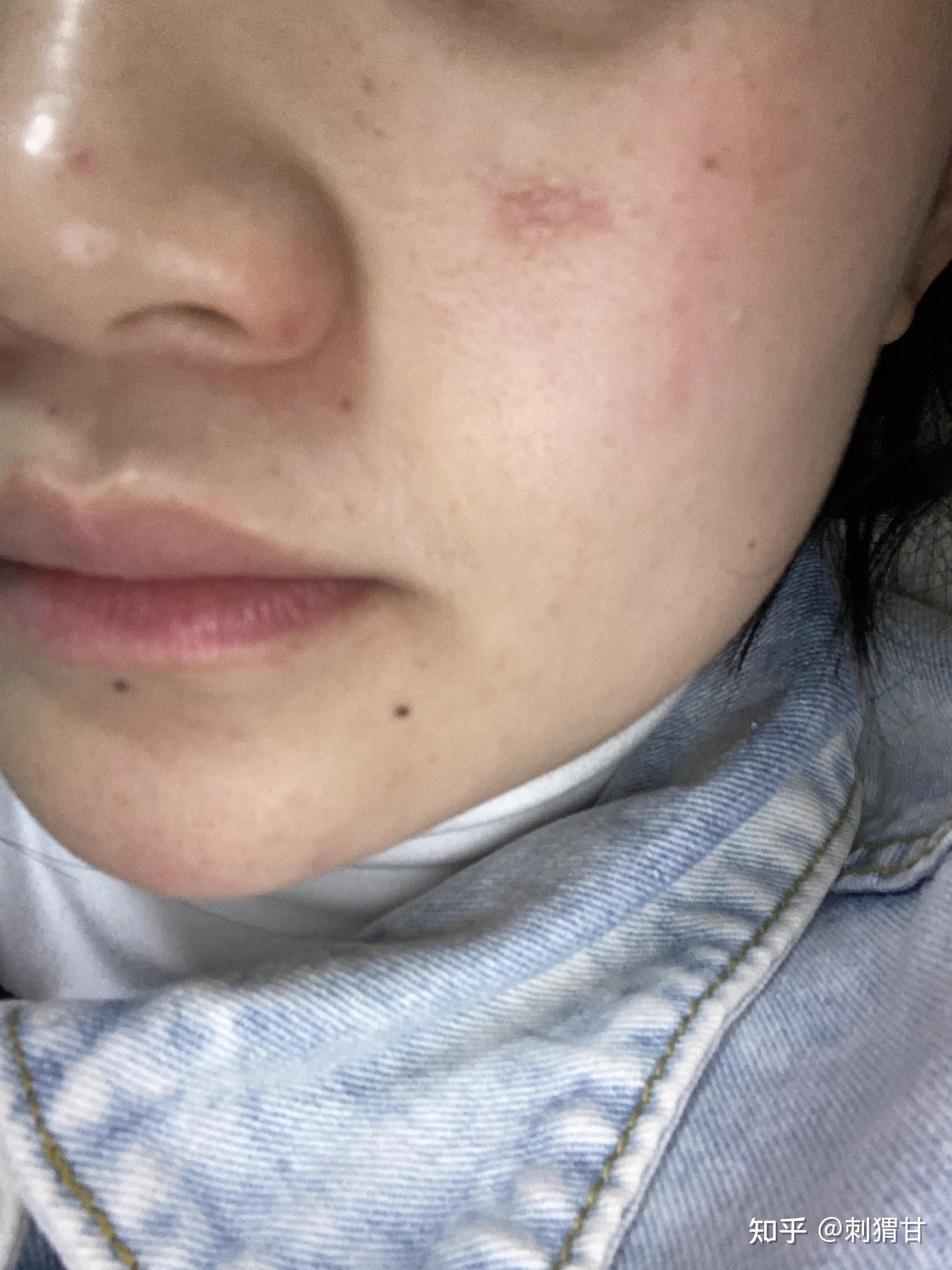 点痣坑大恢复坚持