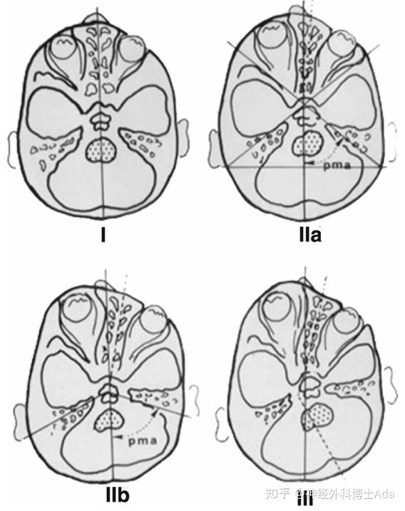 di rocco教授前斜头畸形的分类和手术注意事项