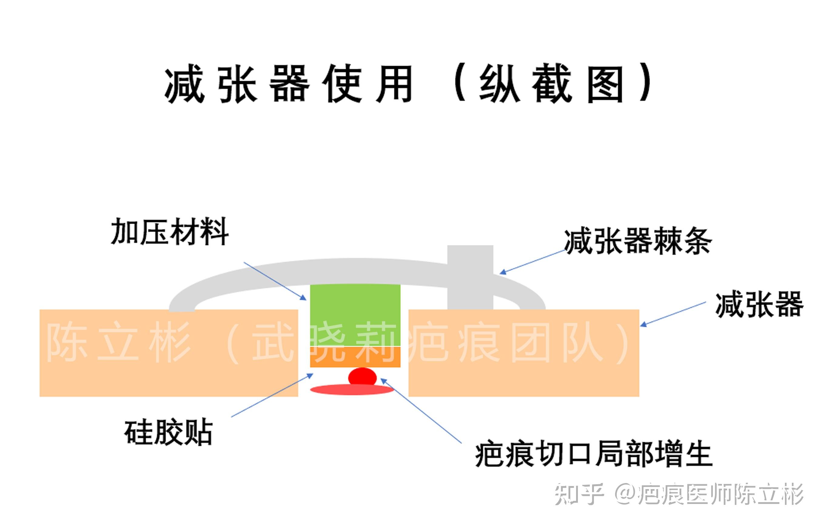 减张器的另类用法