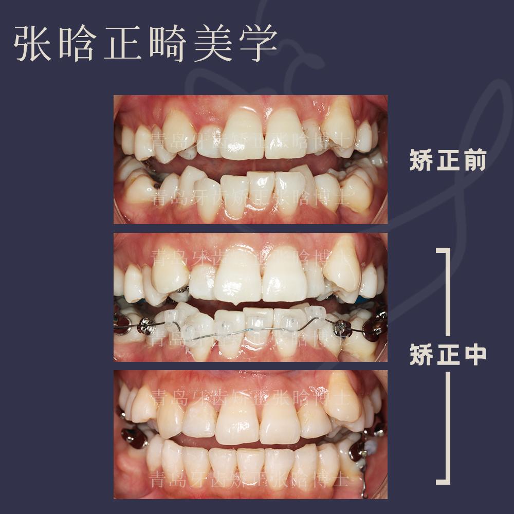 青岛牙齿矫正 | 重度张口受限,牙列不齐陶瓷舌侧矫治