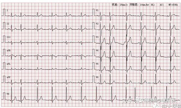 患者女,27岁,图为其正常体检心电图
