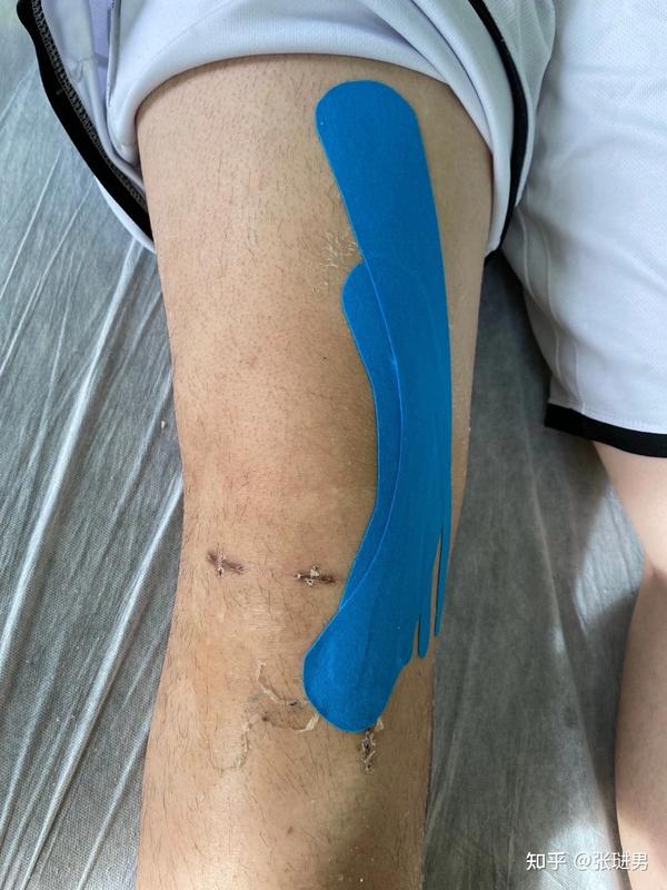 我们主要是让术后患腿得到激活,比如股四头肌和大腿内侧肌群 小腿